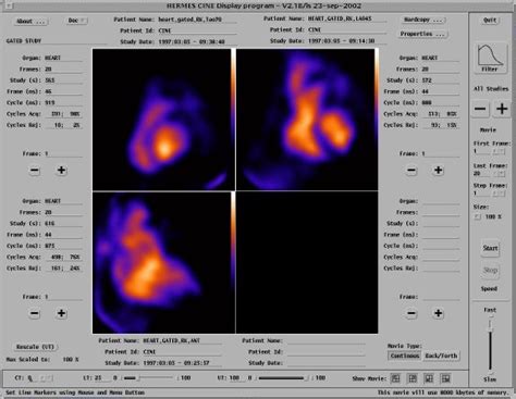 MUGA scan | Nurse, Nuc med, Medical