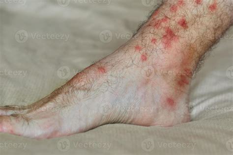 Allergic reaction to insect bites. Male foot with many red spot and ...