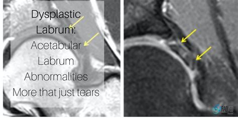 Hip Dysplastic Labrum MRI: Acetabular Labrum More than just tears Part 3 - Radedasia