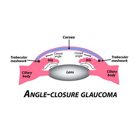 Narrow Angle Eye Condition