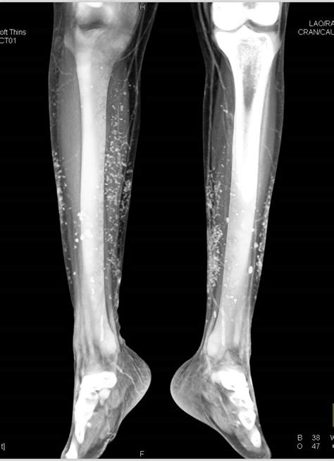 Soft Tissue Calcification in a Patient with Chronic Renal Disease - Musculoskeletal Case Studies ...