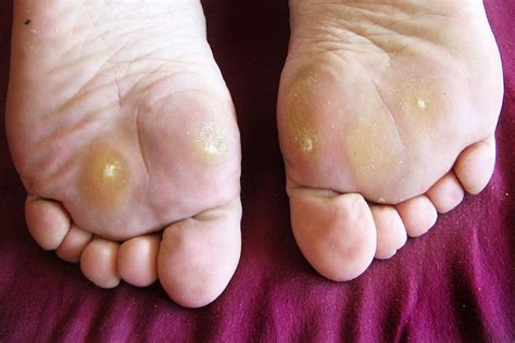 How to Identify and Treat Plantar Warts