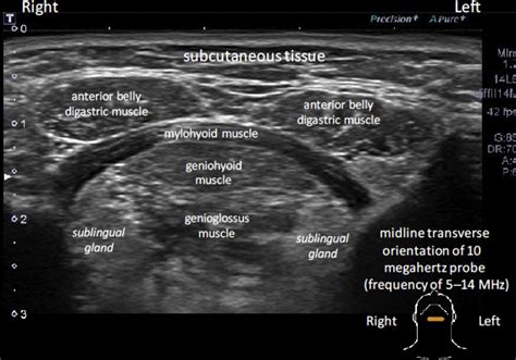 Parotid Gland Ultrasound Measurement