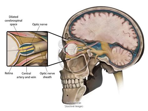 Medical concept shows swelling of the optic nerve caused by increased ...