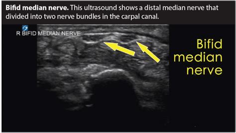 Carpal tunnel syndrome: Non-surgical injections and nerve release treatments