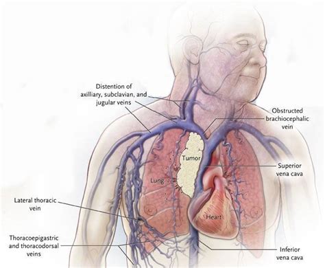 Superior Vena Cava Syndrome: Symptoms, Treatment, And Outlook | Faculty ...