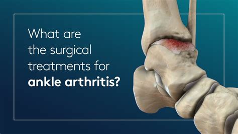 Foot And Ankle Arthritis Causes Symptoms And Treatment – Otosection