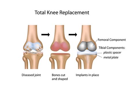 Knee Replacement Surgery Recovery - Explained