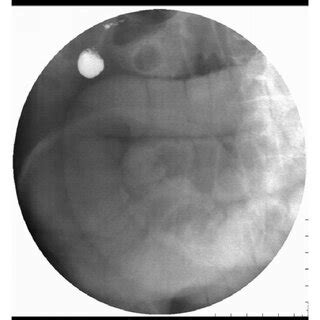 Phytobezoar in the middle segment of the small bowels causing SBO. (a)... | Download Scientific ...