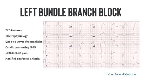 Left Bundle Branch Block - ECG Features, Electrophysiology, Causes & Differential Diagnosis ...