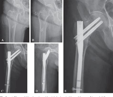 [PDF] Short-term results of surgical treatment with cephalomedullary ...