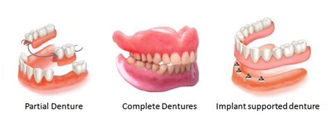 What is the best Denture type for you? Direct Denture Care, Denture Clinic