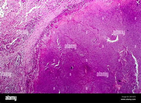 Caseation of human tuberculosis granuloma, light micrograph, photo ...