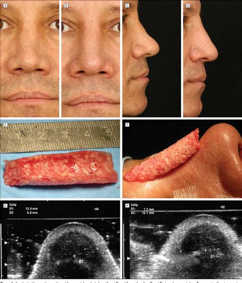 Figure 4 from The diced cartilage glue graft for nasal augmentation. Morphometric evidence of ...