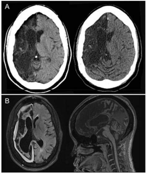Frontiers | Recrudescence of Focal Stroke Symptoms during Pain Management with Hydromorphone