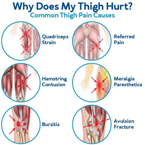 Why Is Your Thigh In Pain? 6 Common Causes– Carex