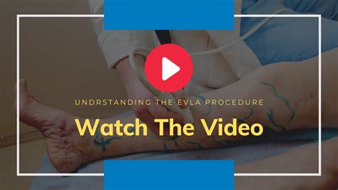 EVLT Minimally Invasive Surgery for Varicose Veins - YouTube