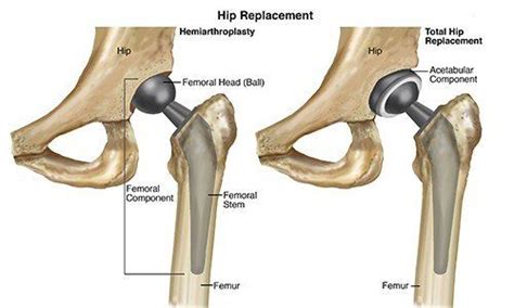 how do you delay a hip replacement - unreinroegner-99