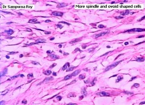 Atypical Fibroxanthoma - Histopathology Image3 - Histopathology-India.net - (Pathology Quiz ...