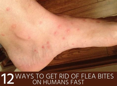 What Do Flea Bites Look Like On Cats