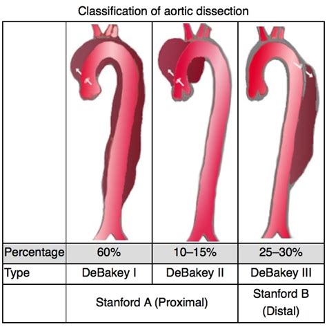 Aortic Dissection