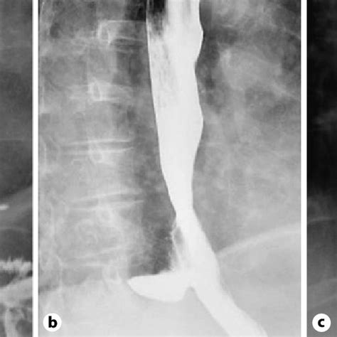 Barium study showing a large epiphrenic diverticulum. a, b After... | Download Scientific Diagram