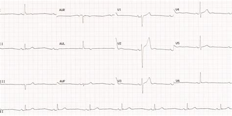 Sinus bradycardia – All About Cardiovascular System and Disorders