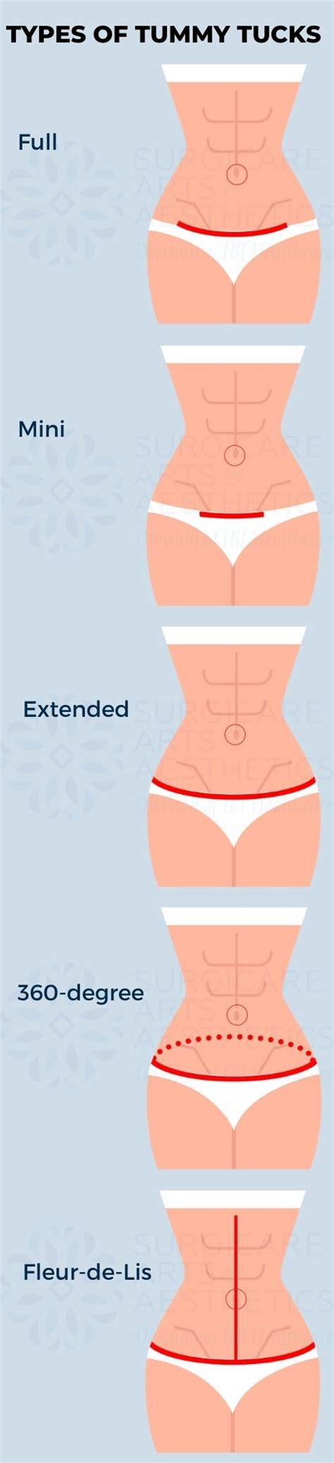 360 Tummy Tuck in Atlanta, GA - Circumferential Abdominoplasty