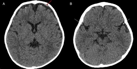 Subdural Hematoma In Month Old Ct Scan Stock Image C | My XXX Hot Girl