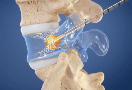 Intracept® Procedure | Treatments | Twin Cities Pain Clinic