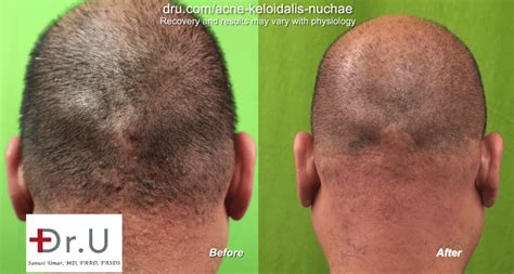 Video- Los Angeles Acne Keloidalis Nuchae Laser Treatment Cure By Dr U