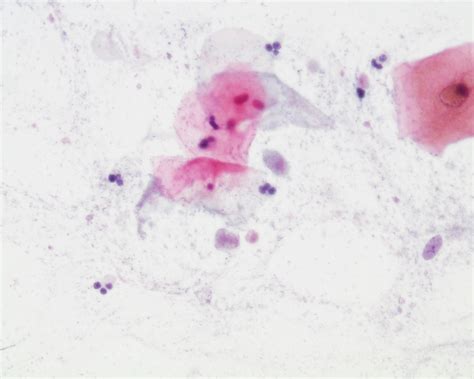 Trichomonas