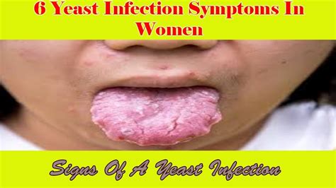 Yeast Infection Symptoms