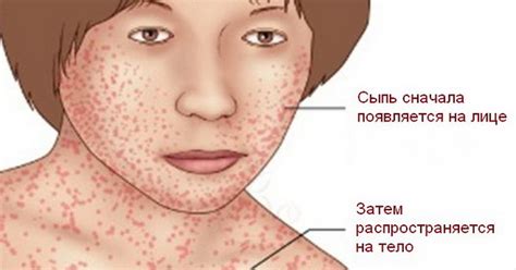 Ms rash on face: Understanding Multiple Sclerosis (MS) Skin Lesions