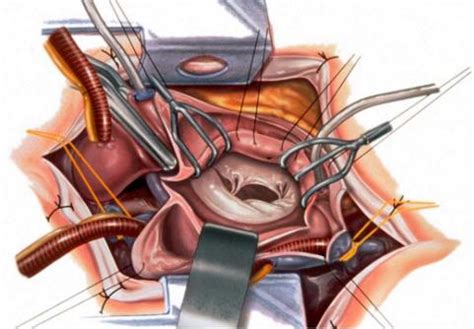 Minimally Invasive Surgery for Mitral Valve Disease to be Tested in ...