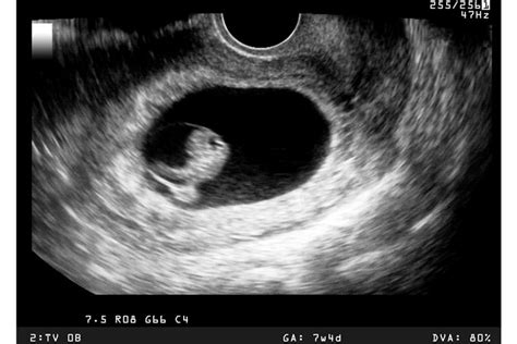 Wrong due date from ultrasound scan - why it happens - MadeForMums