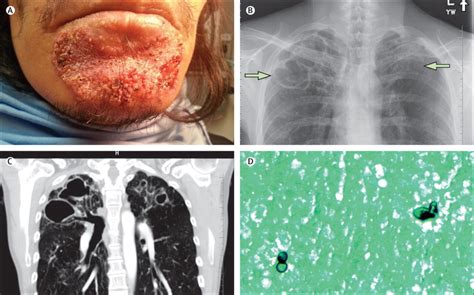 Disseminated blastomycosis with cutaneous involvement in a Canadian ...