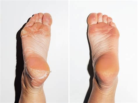 Reviewed: The Baby Foot Peel for Dead Skin and Calluses (Is It Safe and ...