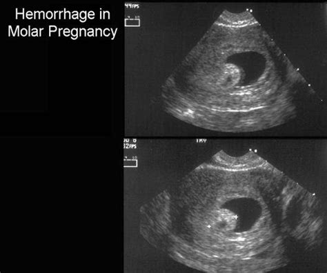 How Early Can A Molar Pregnancy Be Detected By Ultrasound - PregnancyWalls