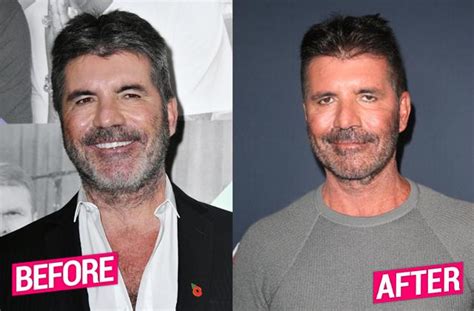 Simon Cowell Plastic Surgery Makeover Exposed By Top Docs