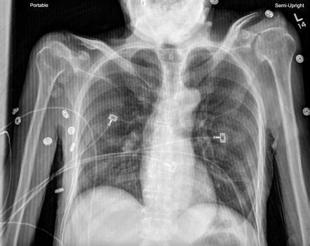 X-ray artifacts | Radiology Reference Article | Radiopaedia.org