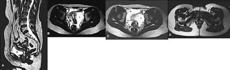 Sumergido Doctrina Alcalde mri female pelvis anatomy Frente Casco Madurar