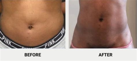 What Are The Best Non-Surgical Tummy Tuck Alternatives?