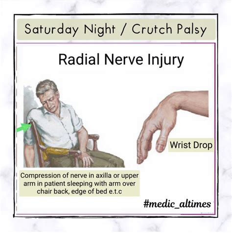 Saturday Night Palsy – MEDICAL TIMES