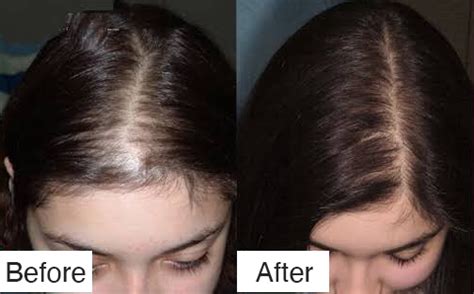 MEN AND WOMEN ANDROGENIC ALOPECIA - INNOAESTHETICS