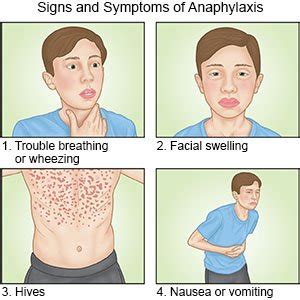 Anaphylaxis Symptoms / Anaphylaxis Symptoms & Signs | Allergy Insider ...