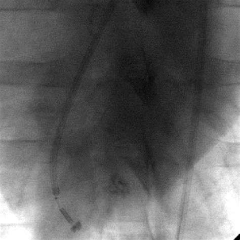 Needle Injection Catheter - Tip - Lubrizol