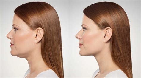 Double Chin Treatment - Kybella Springfield MO