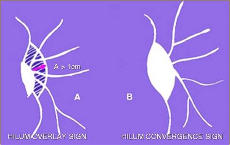 Chest Xray - Approach to hilum | Epomedicine