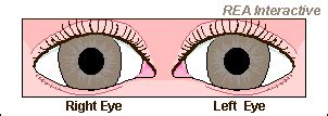 Richmond Eye Associates, Relative Afferent Pupillary Defect